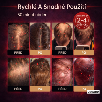 DermaHat™ -  Čepice pro obnovu růstu vlasů